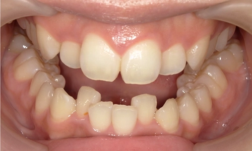 前歯のデコボコ