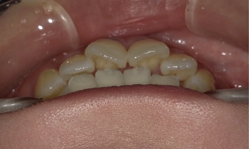 前歯が出ている