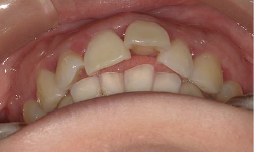 出っ歯・ガタガタ