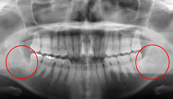 親知らずの抜歯