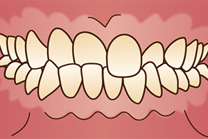 交叉咬合