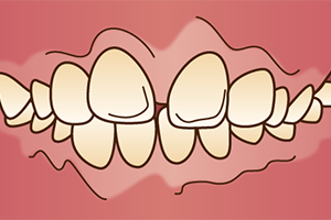 出っ歯