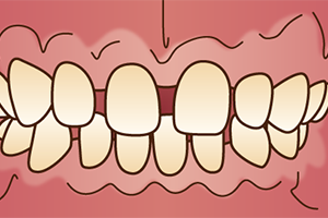 すきっ歯