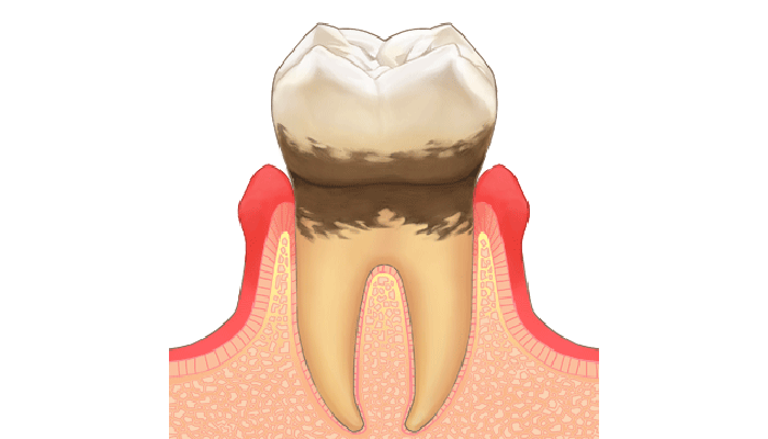 軽度歯周病
