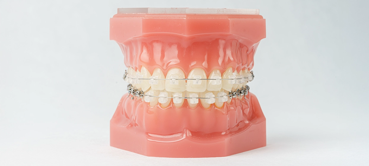 表側・裏側のワイヤー矯正にも対応可能