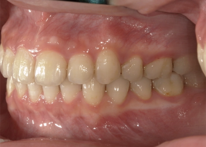 噛んだ状態・ギリギリ横に動かした状態