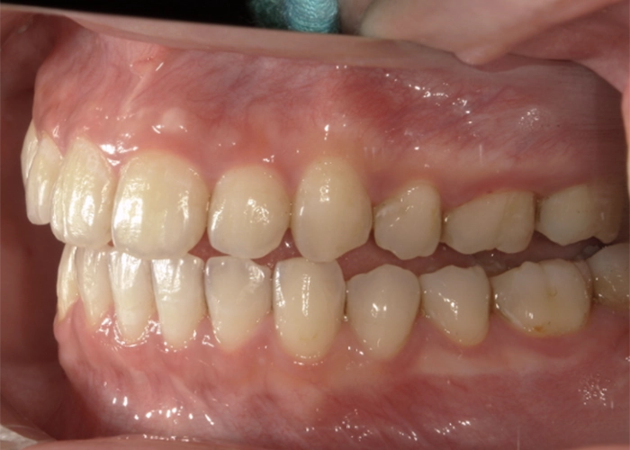 噛んだ状態・ギリギリ横に動かした状態